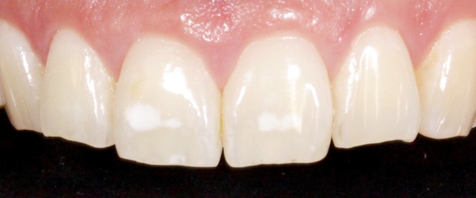 Macchie bianche sui denti: cosa sono le &ldquo;white spot&rdquo; e come liberarsene